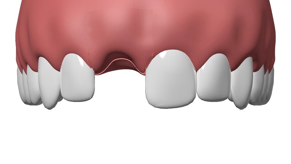 Implant dentaire Nimes 1